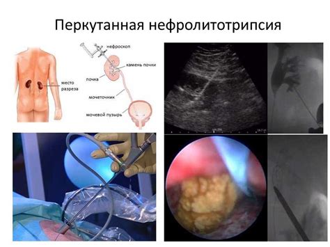 Причины проведения повторной цистоскопии после удаления камней