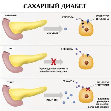 Причины развития лада диабета