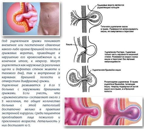 Причины развития паховой грыжи у женщин