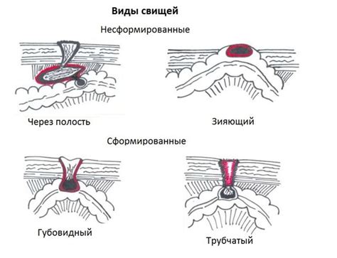 Причины разрыва шва после эпизио