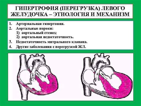 Причины систолической перегрузки левого желудочка