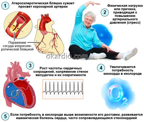 Причины стенокардии напряжения ФК 2