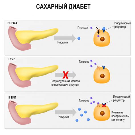 Причины тремора при сахарном диабете