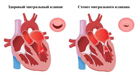 Причины эктопического крепления хорд митрального клапана