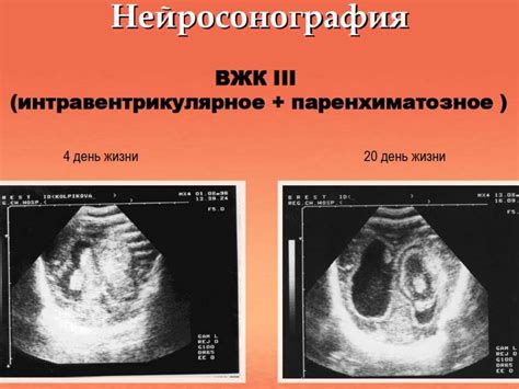 Проблема поражения головного мозга у новорожденных