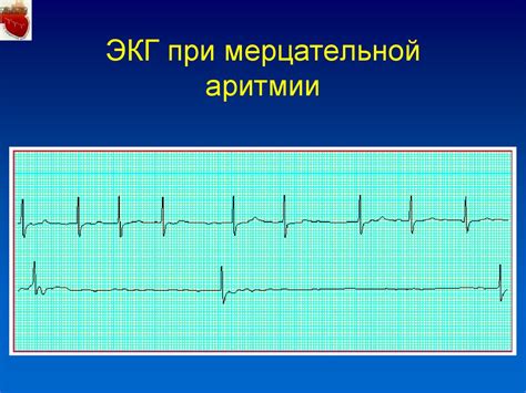 Проблемы при исследовании мерцательной аритмии на ЭКГ