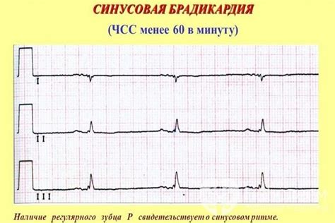 Проведение ЭКГ-исследования