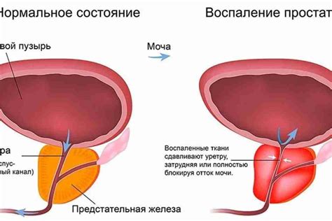 Простатит: причины и симптомы