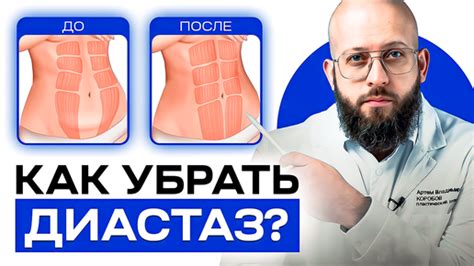 Профессиональные методы лечения диастаза на животе