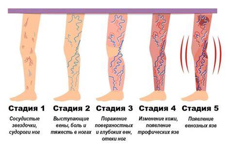 Профилактика бляшек в венах ног