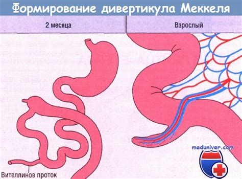 Профилактика дивертикула Меккеля у детей