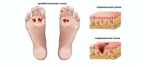 Профилактика и лечение язв при сахарном диабете