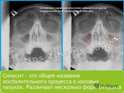 Профилактика образования слизи в носовых пазухах