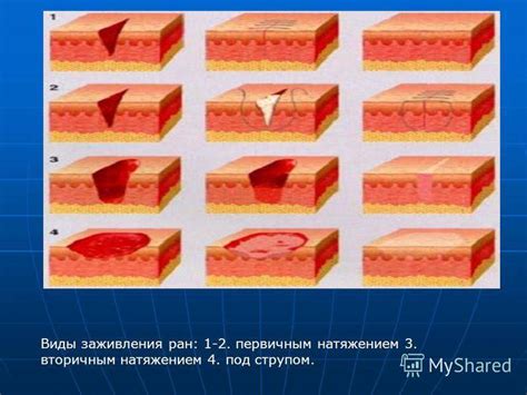 Профилактика повторного появления незаживающих ран на ноге