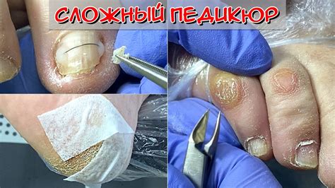 Профилактика появления мозоли на мизинце ноги