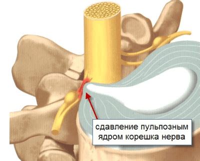 Профилактика фасеточного синдрома шейного отдела