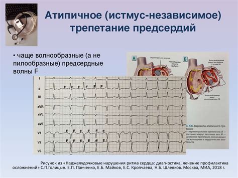 Профилактика фибрилляции предсердий и трепетания предсердий