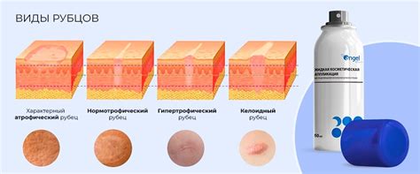 Профилактические меры для предотвращения шрамов