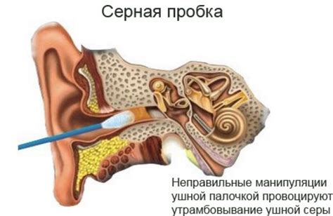 Профилактические меры для предотвращения шума в ушах