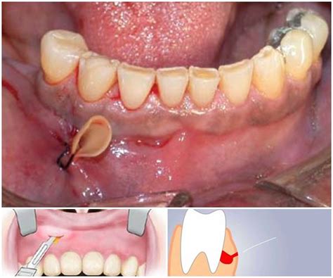 Процедура проведения дренажа в десне