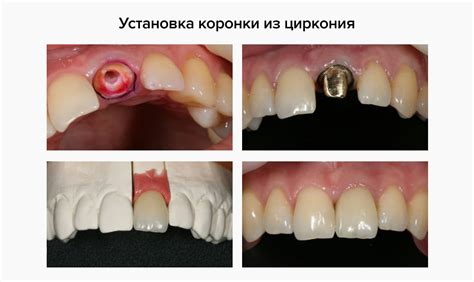 Процесс снятия циркониевой коронки