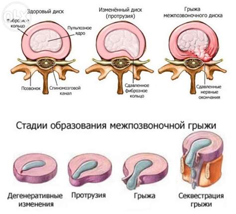 Проявления грыж дисков шейного отдела позвоночника