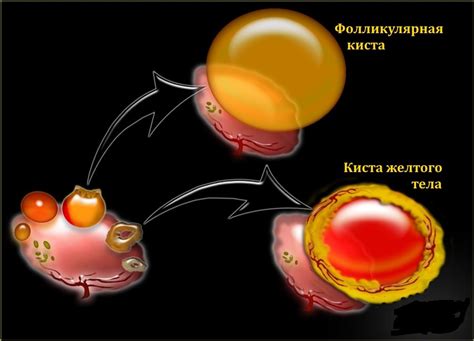 Развитие кисты яичника