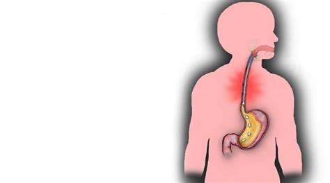 Раздражение пищевода