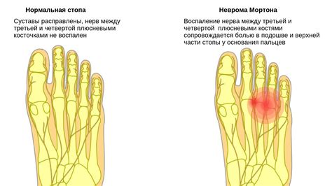 Различия между подошвенным и верхним боем