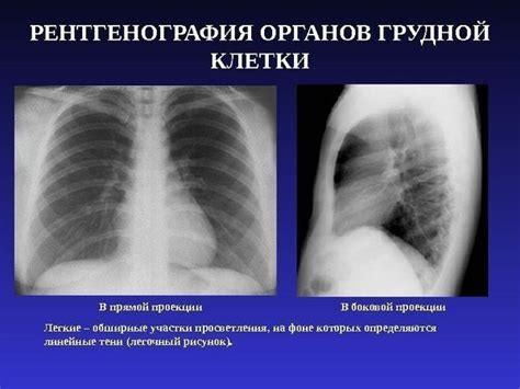 Различия между рентгенографией и флюорографией легких