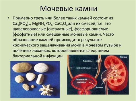 Различные причины образования мочевых камней