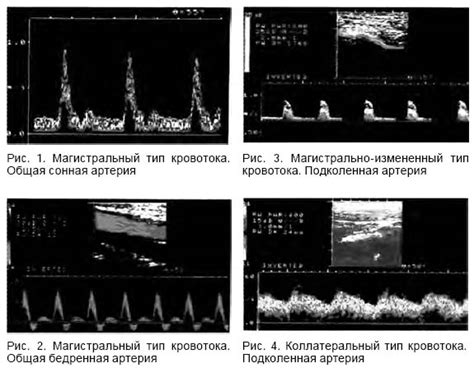 Различные типы кровотока