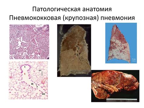 Разрушение легочной ткани