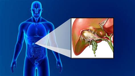 Разрыв желчного пузыря