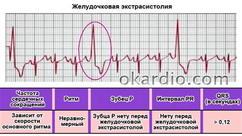 Ранняя желудочковая экстрасистолия