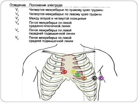 Расположение электродов на груди ребенка