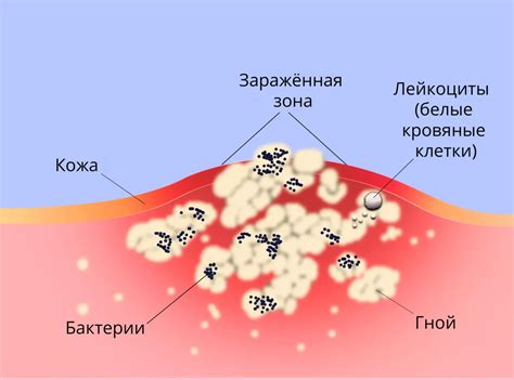 Распространение воспаления на соседние области кожи