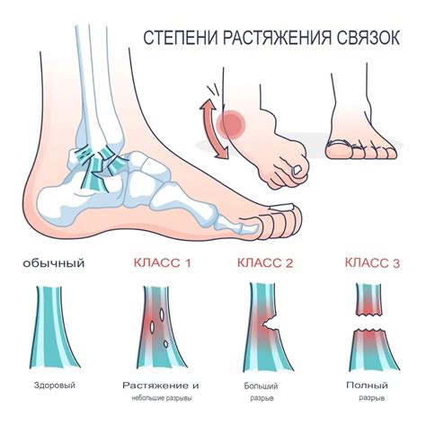 Растяжение связок в результате активного спорта или тренировок