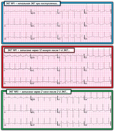 Расшифровка результатов ЭКГ и возможные диагнозы