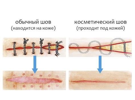 Режимы заживления шва