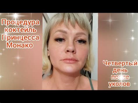 Рекомендации после процедуры монако