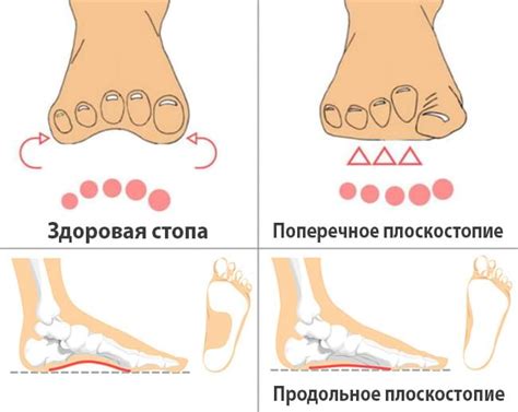 Рекомендации по измерению степени плоскостопия