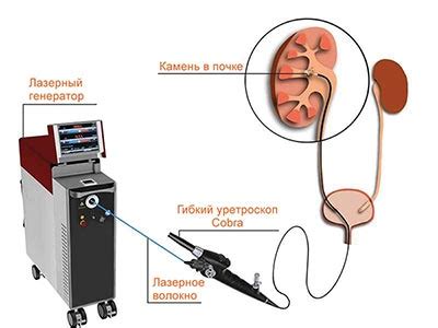 Рекомендации по проведению цистоскопии после удаления камней