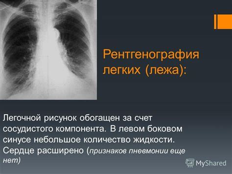 Рекомендации специалистов для укрепления сосудистого компонента легочного рисунка