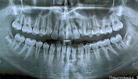 Рентгенография зубов