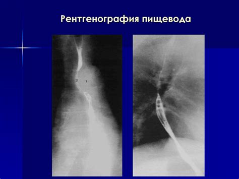 Рентгеноскопия пищевода