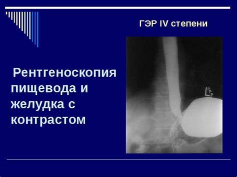 Рентгеноскопия пищевода: суть процедуры и контрастные вещества