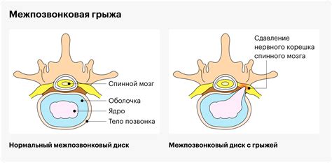 Решение проблем с межпозвонковыми грыжами