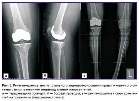 Роль артроскопической санации в лечении повреждений левого коленного сустава