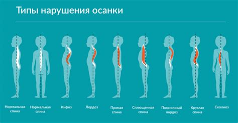 Роль родителей в профилактике кифотической осанки